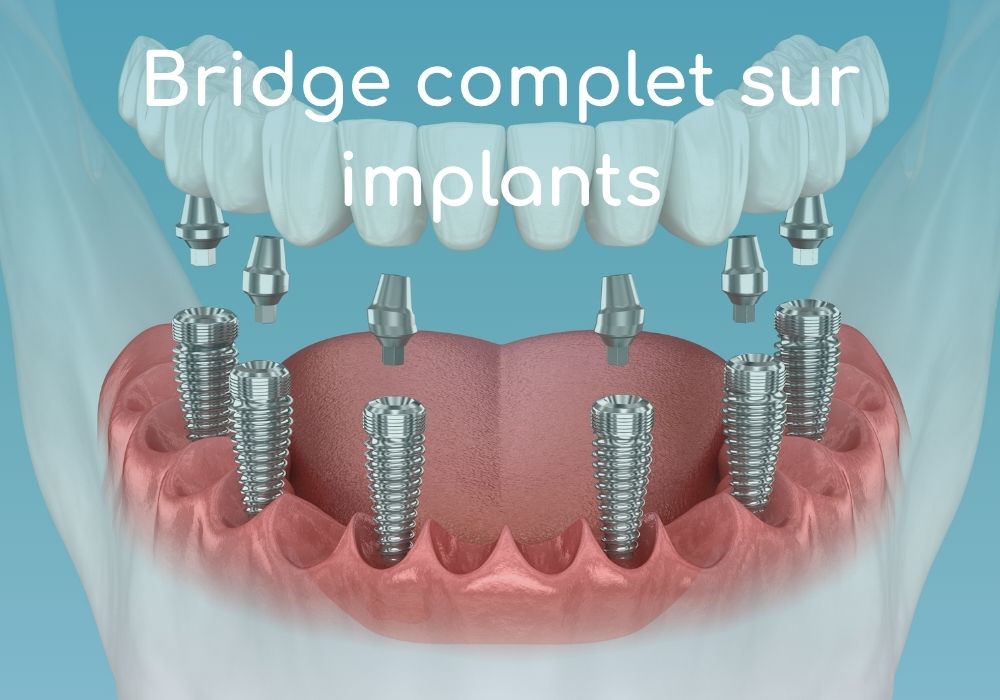 bridge-complet-sur-implants-dentiste-sene-dr-benoit-lenfant