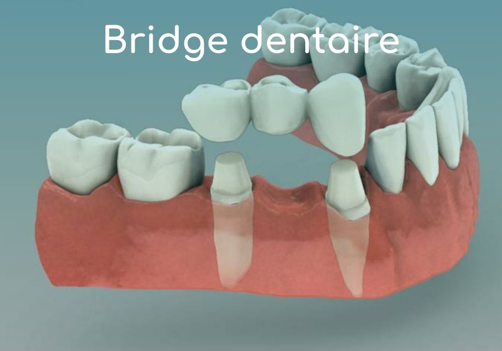 bridge-dentaire-cabinet-dentaire-idro-dentiste-sene