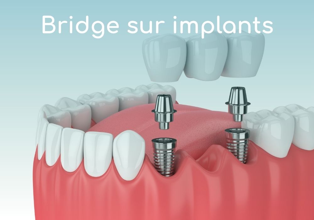 bridge-sur-implants-dr-benoit-lenfant-cabinet-dentaire-idro-sene