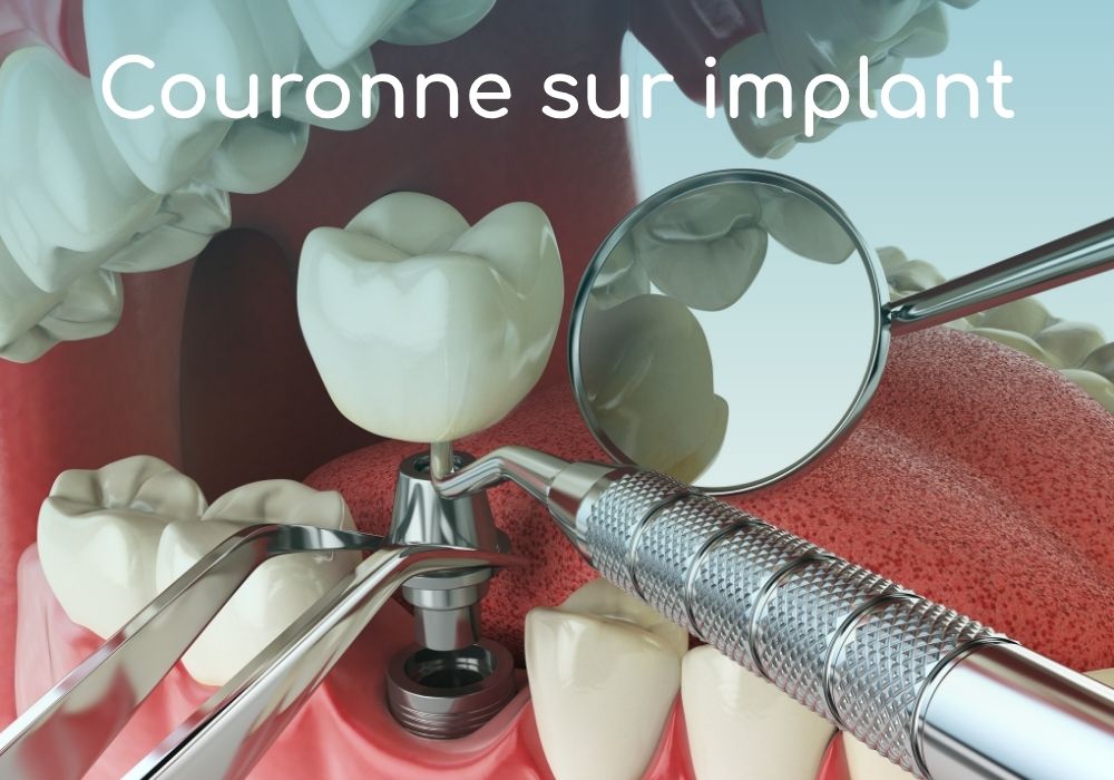 couronne-sur-implant-dentaire-cabinet-dentaire-idro-dr-benoit-lenfant-dentiste-sene