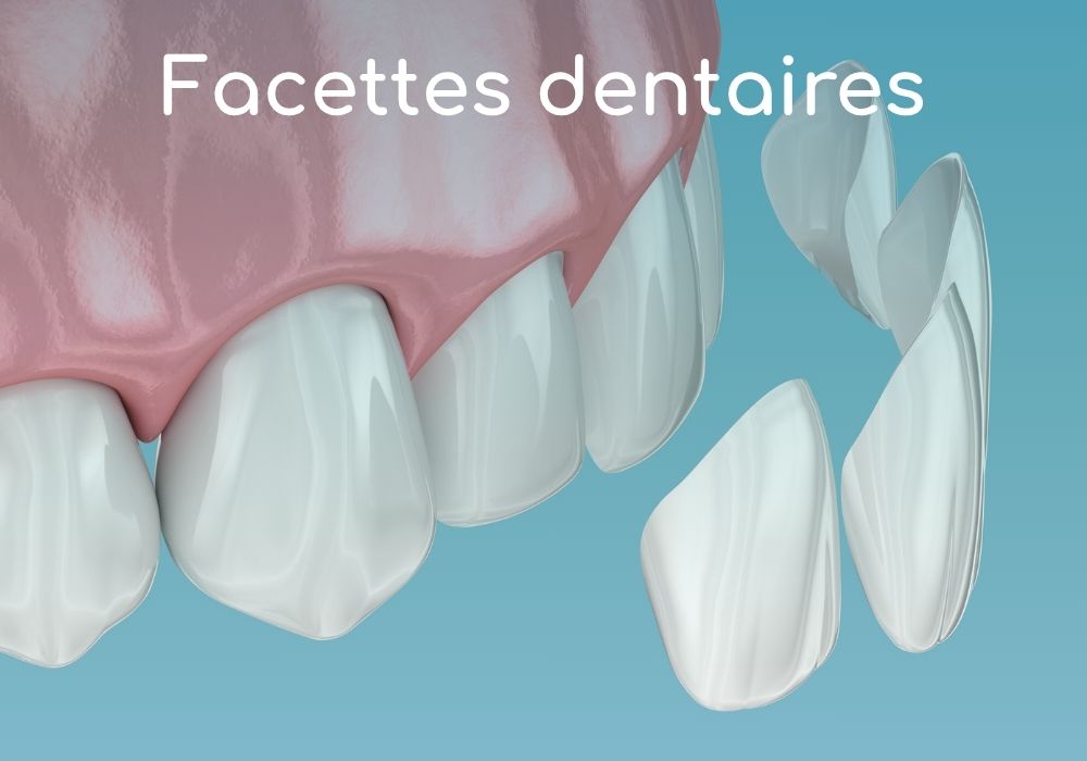 facettes-dentaires-dr-benoit-lenfant-cabinet-dentaire-idro