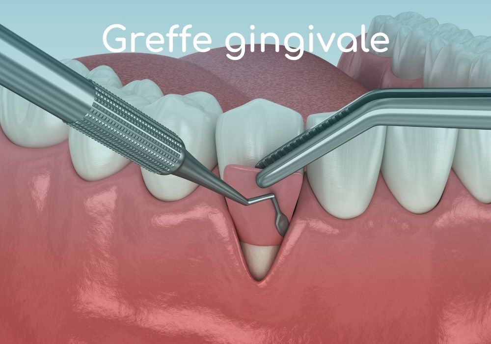 greffe-gingivale-dr-benoit-lenfant-dentiste-sene-parodontologie