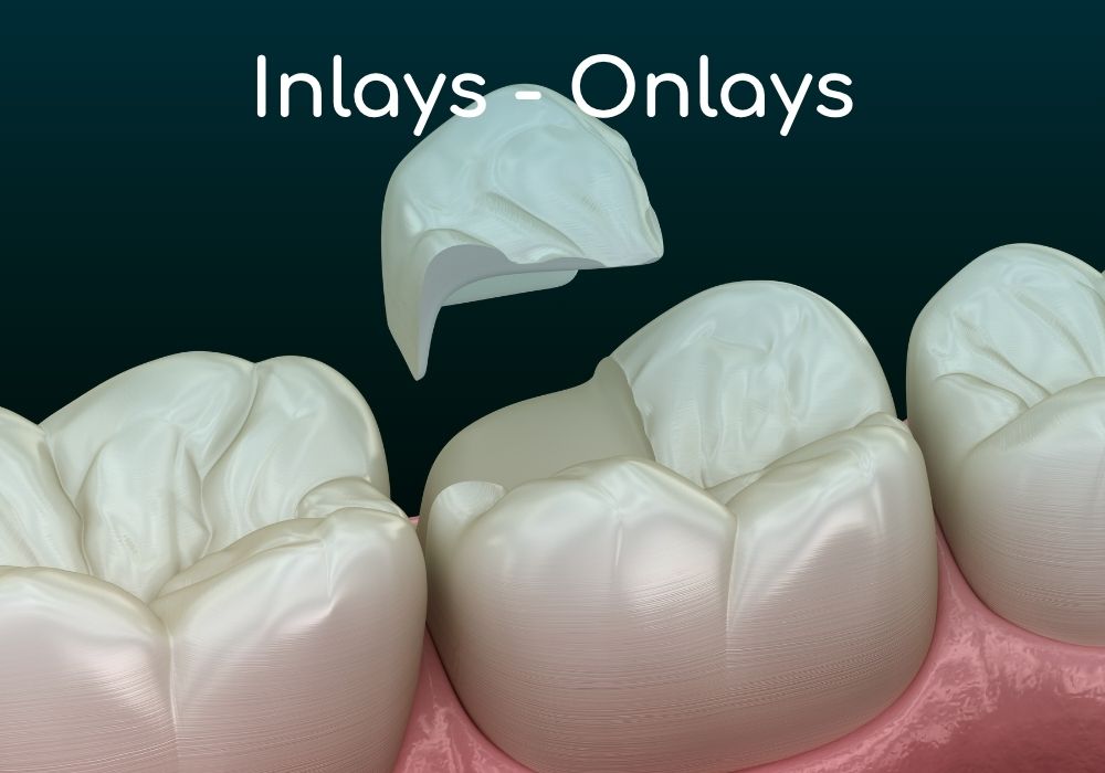 inlays-onlays-dentaires-cabinet-idro-dentiste-sene-dr-benoit-lenfant