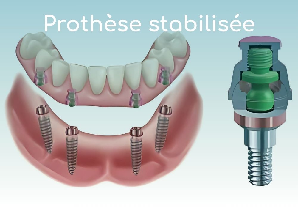 prothese-stabilisee-sur-implant-cabinet-dentaire-idro-dentiste-sene