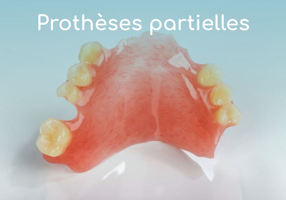 protheses-partielles-dentiste-sene-dr-benoit-lenfant