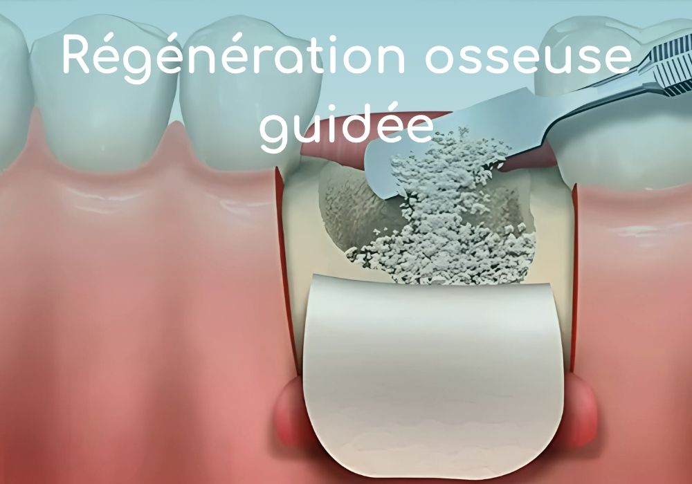 regeneration-osseuse-guidee-dr-benoit-lenfant-dentiste-sene-parodontologie