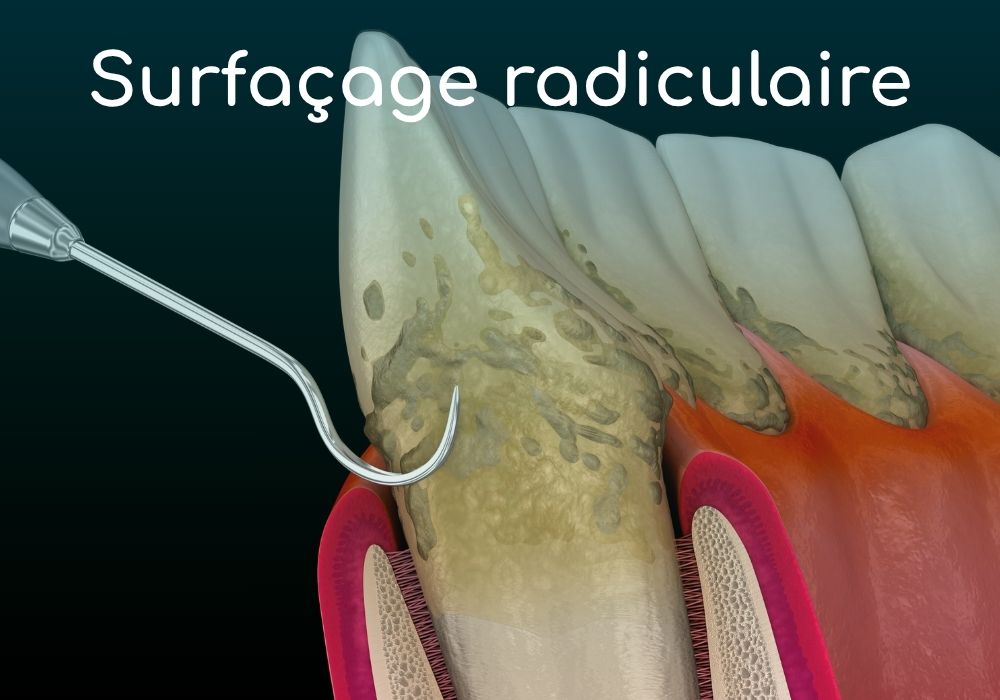 surfaçage-radiculaire-dr-benoit-lenfant-dentiste-sene-parodontologie