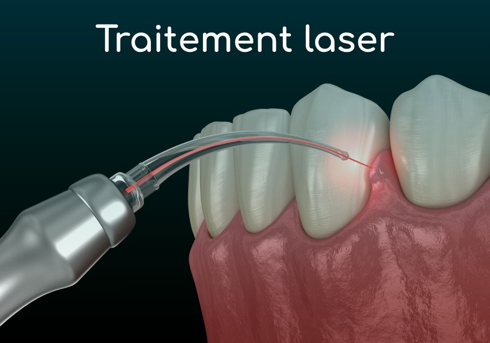 traitement-laser-maladies-parodontales-dr-benoit-lenfant-dentiste-sene